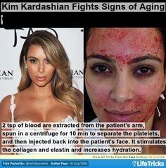 Vampire facelift Washington DC Vampire facelift Washington DC